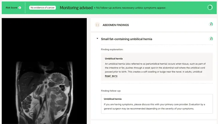 MRI abdomen scan showing umbilical hernia finding and follow-up guidance