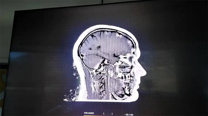 MRI scan showing detailed cross-sectional imaging